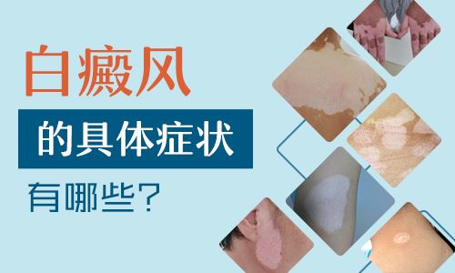 面部白癜风该怎么护理好?